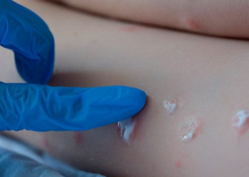 Detectaron el primer caso sospechoso de viruela del mono en la Argentina