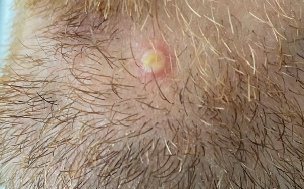 Confirmaron la segunda muerte por viruela símica en Argentina