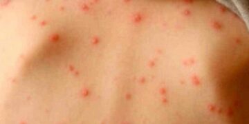 El mayor brote en más de una década: Bolivia registró 175 casos de sarampión en tres meses