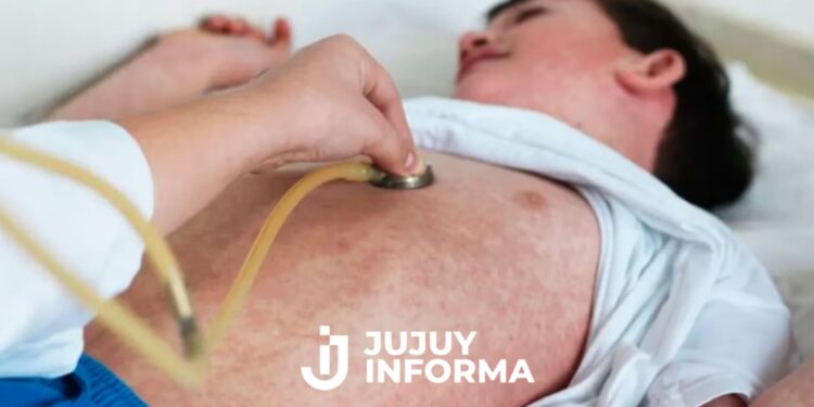 El Ministerio de Salud emitió una alerta por la circulación en varias provincias de una familia con sarampión
